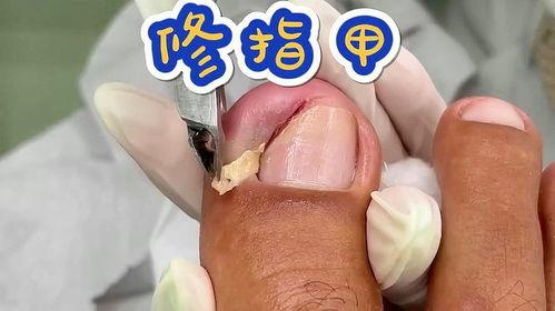 修脚指甲视频,轻松掌握专业修脚技巧